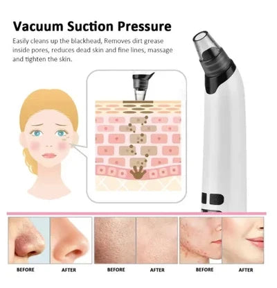 Face Vacuum Suction Blackhead Remover – Electric Pore Cleaner
